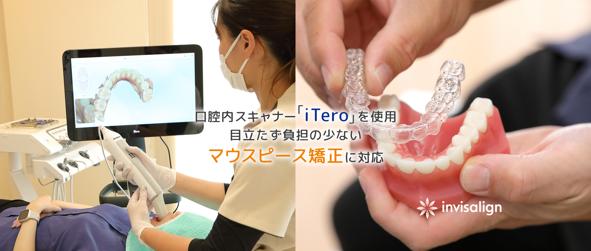 口腔内スキャナー「iTero」を使用目立たず負担の少ないマウスピース矯正に対応