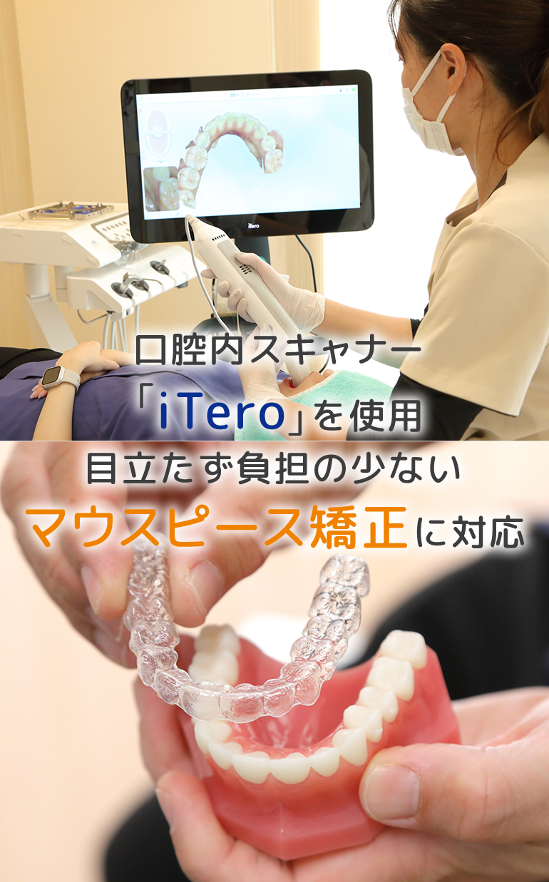 口腔内スキャナー「iTero」を使用目立たず負担の少ないマウスピース矯正に対応