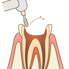 歯を削る