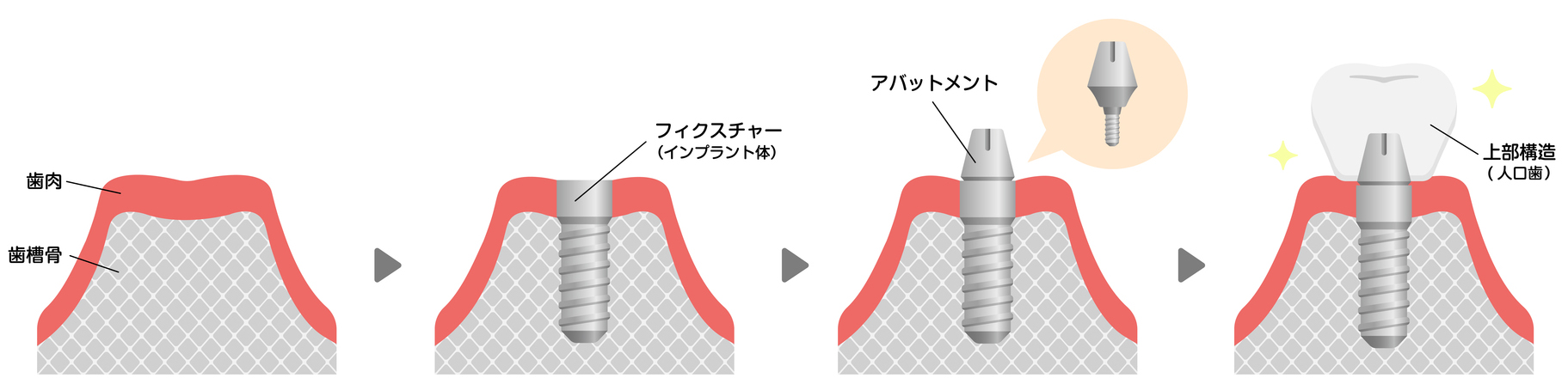 インプラント治療の流れ