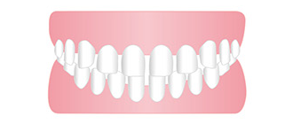 空隙歯列/正中離開（すきっ歯）