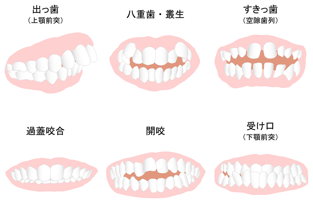 お子様にこのような症状はありませんか？子供の悪い歯並びの種類