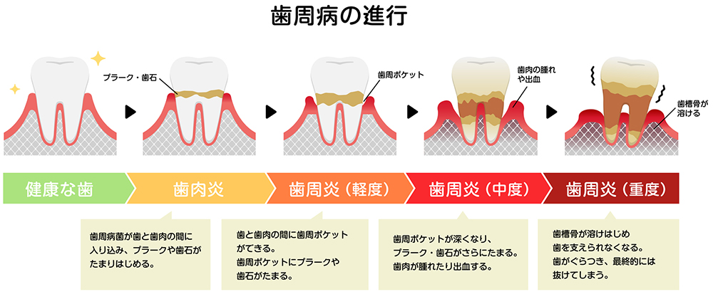 放っておくと手遅れに…あなたの進行度は？